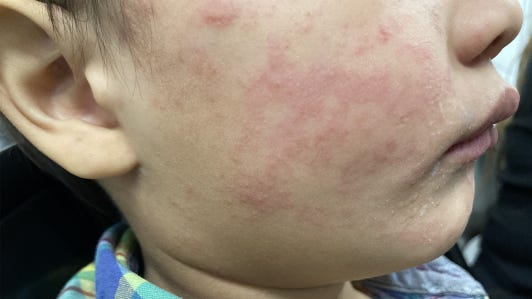 87976566007-measles-rash