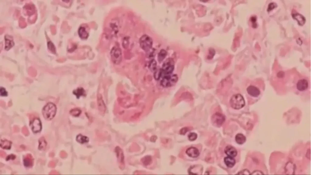 ohio-confirms-first-measles-outbreak-of-2026-vacci-ohio-confirms-first-measles-outbreak-of-2026-vacc