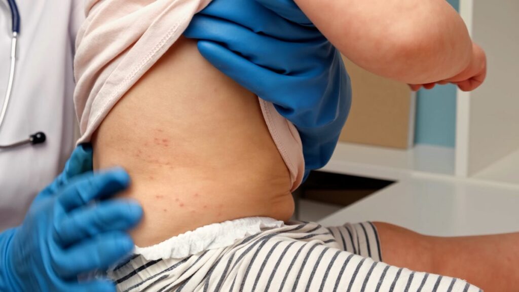 79241849007-measles-outbreak