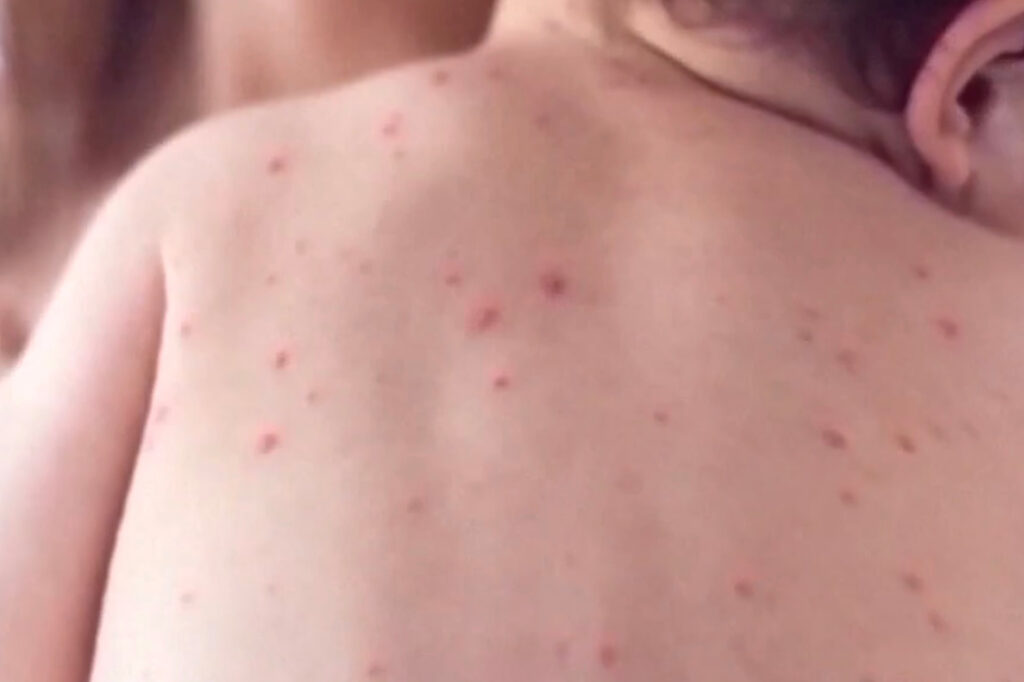 measles-9