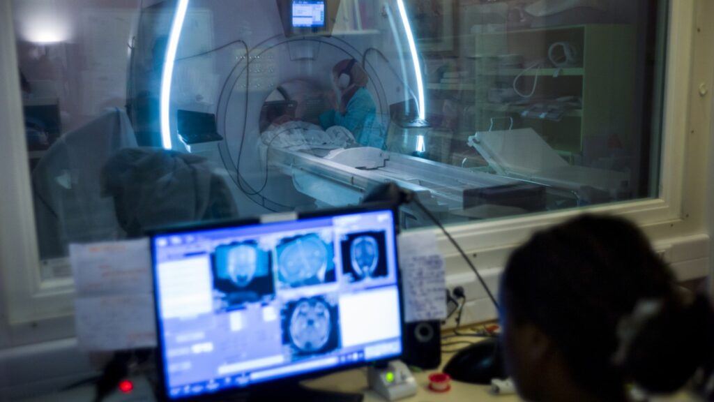alzheimers-disease