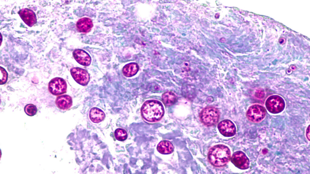 cyclosporiasis